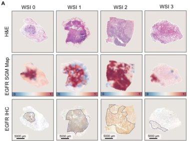 AI病理大模型实现肺癌基因突变快速预测，准确率高达99%