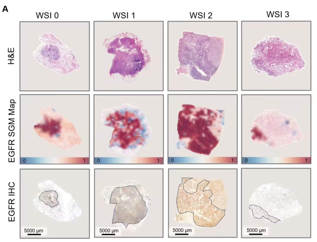 AI病理大模型实现肺癌基因突变快速预测，准确率高达99%